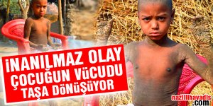İnanılmaz Olay:Çocuğun vücudu taşa dönüşüyor