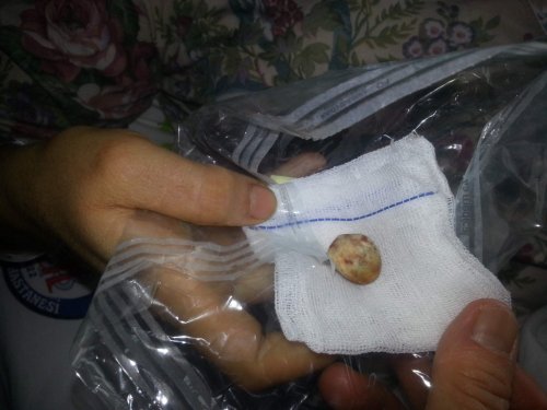 Safra Kesesinden Çıkan Taşın Büyüklüğü Şaşırttı