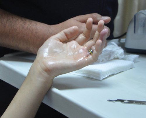Yüzüğü Çıkartamayan Kadın İçin Hastane Seferber Oldular